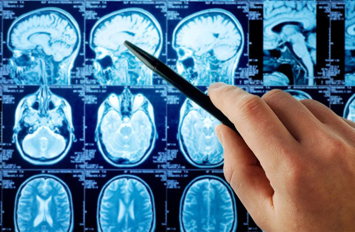 Brain Tumor