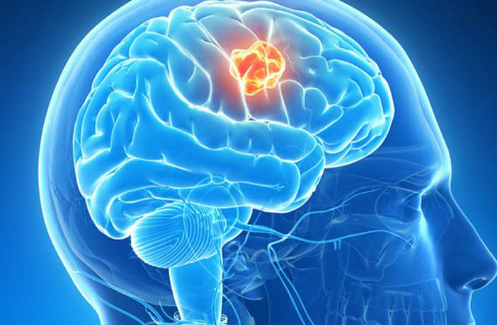 Brain Tumor