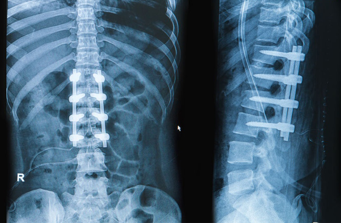 Spine surgey