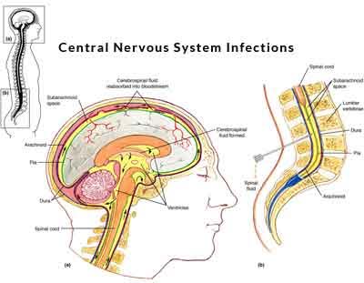 Central Nervous System Infections