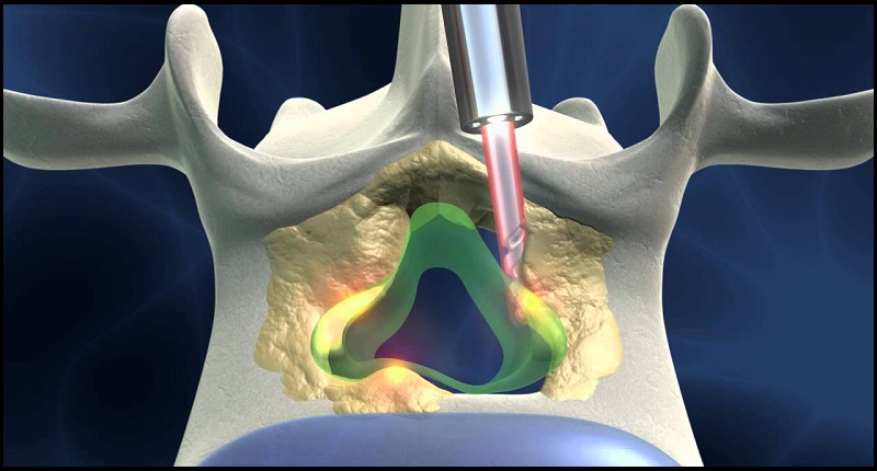 Micro Endoscopic Surgery