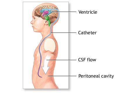TREATMENT FOR HYDROCEPHALUS