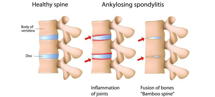SPONDYLITIS TREATMENT