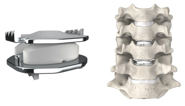 Artificial Cervical Disc