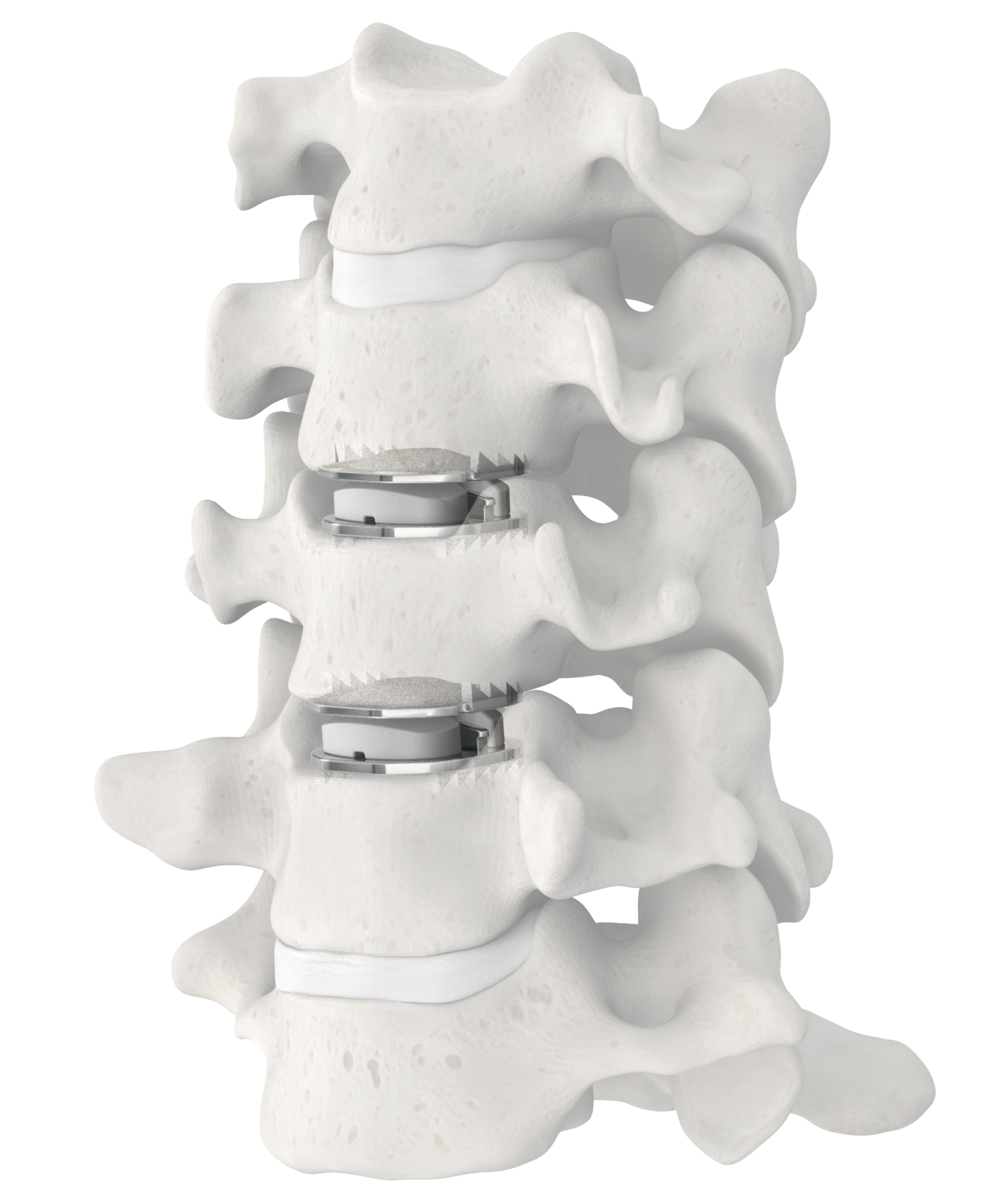 Artificial Cervical Disc
