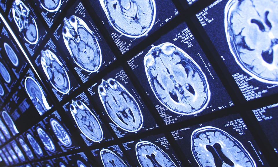 Functional Neurosurgery