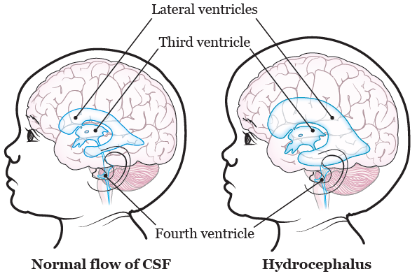 TREATMENT FOR HYDROCEPHALUS