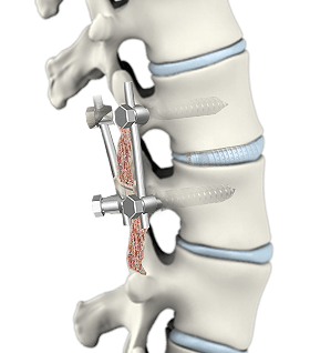 Spine Surgery Minimal Access