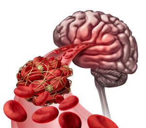 Stroke Treatments